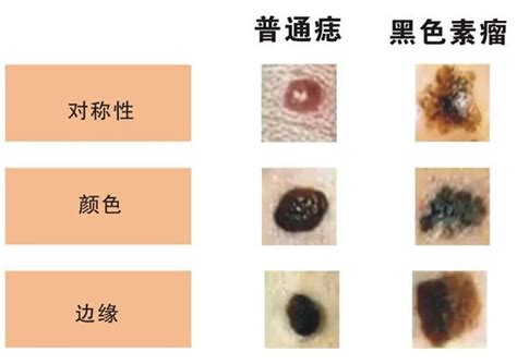 痣長在臉上|是痣還是瘤？黑色素瘤的類型、症狀與治療